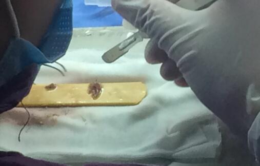 種頭發(fā)有用嗎?種植頭發(fā)恢復(fù)過(guò)程真實(shí)案例