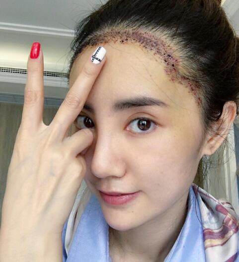 種頭發(fā)有用嗎?種植頭發(fā)恢復(fù)過(guò)程真實(shí)案例