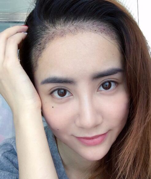 種頭發(fā)有用嗎?種植頭發(fā)恢復(fù)過(guò)程真實(shí)案例