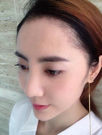 種頭發(fā)有用嗎?種植頭發(fā)恢復(fù)過(guò)程真實(shí)案例