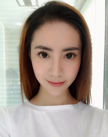 種頭發(fā)有用嗎?種植頭發(fā)恢復(fù)過(guò)程真實(shí)案例