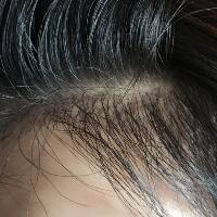 發(fā)際線種植果圖和經(jīng)歷分享——南京明基整形醫(yī)院