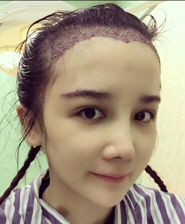 發(fā)際線種植果圖和經(jīng)歷分享——南京明基整形醫(yī)院