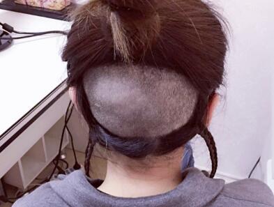 發(fā)際線種植果圖和經(jīng)歷分享——南京明基整形醫(yī)院