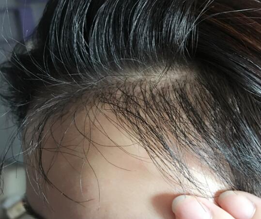 發(fā)際線種植果圖和經(jīng)歷分享