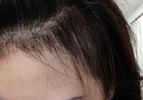 發(fā)際線種植果圖和經(jīng)歷