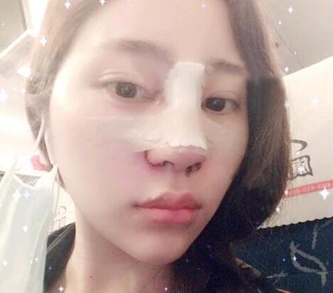 隆鼻整形前后對比圖和恢復過程