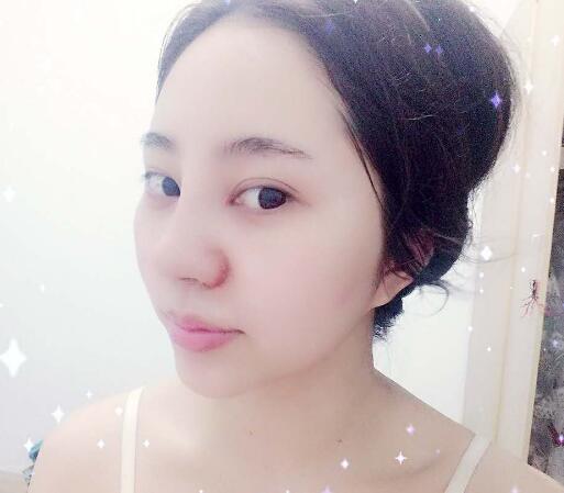 隆鼻整形前后對比圖和恢復過程