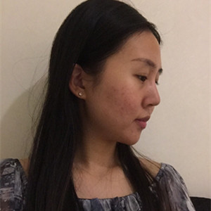 光子嫩膚手術(shù)前后過程以及對(duì)比照片分享，武漢美都朱紅霞醫(yī)生做的