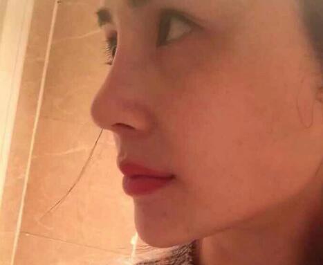 鼻子綜合整形前后對比圖,恢復過程