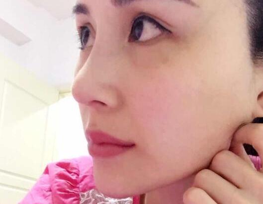 鼻子綜合整形前后對比圖