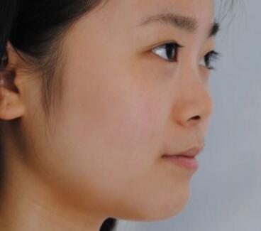 隆鼻整形價(jià)格和真實(shí)恢復(fù)期圖片