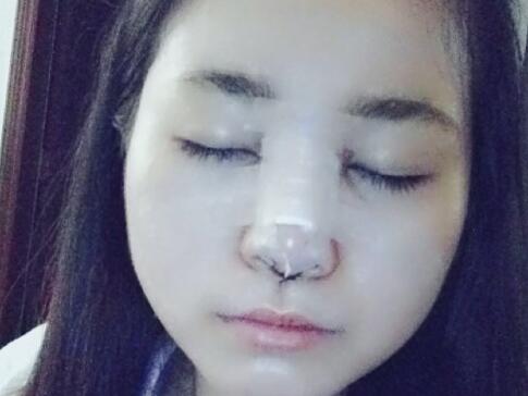 隆鼻整形價(jià)格和真實(shí)恢復(fù)期圖片