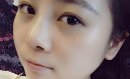 隆鼻整形價(jià)格和真實(shí)恢復(fù)期圖片