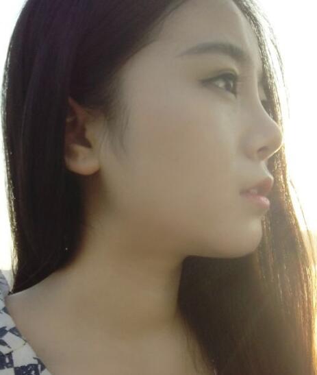 隆鼻整形價(jià)格和真實(shí)恢復(fù)期圖片