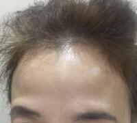 去抬頭紋方法？杭州悅可整容推薦注射瘦臉去抬頭紋魚尾紋