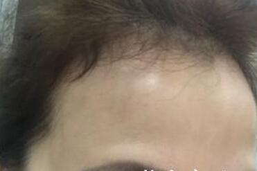 去抬頭紋很好的方法?注射瘦臉去抬頭紋魚尾紋