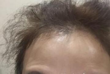 去抬頭紋很好的方法?注射瘦臉去抬頭紋魚尾紋