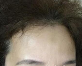 去抬頭紋很好的方法?注射瘦臉去抬頭紋魚尾紋