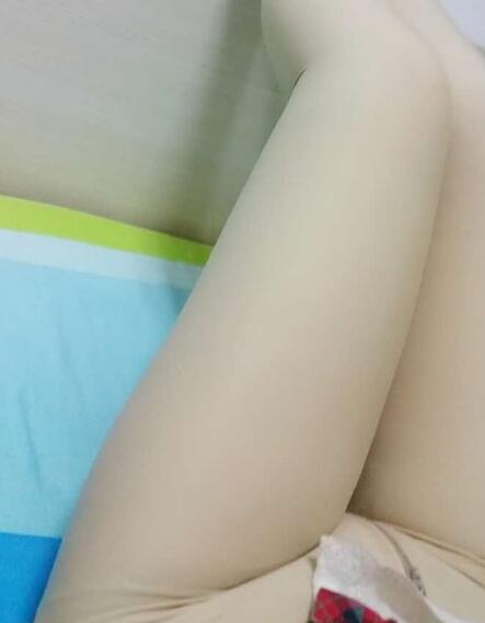 吸脂減肥瘦大腿前后對比圖，光纖溶脂瘦大腿較有的方法真實案例