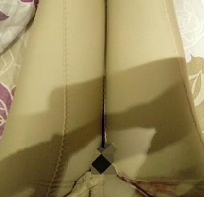 吸脂瘦大腿前后對比圖，水動力吸脂瘦大腿真實案例多對比圖經歷