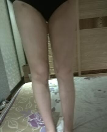 吸脂瘦大腿前后對比圖，水動力吸脂瘦大腿真實案例多對比圖經歷