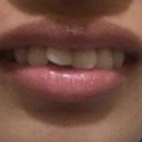 在成都圣貝牙科醫(yī)院做了兩顆純鈦烤瓷牙價(jià)格4800元