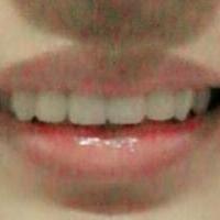 在成都圣貝牙科醫(yī)院做了兩顆純鈦烤瓷牙價(jià)格4800元