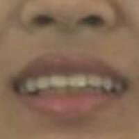 在成都圣貝牙科醫(yī)院做了兩顆純鈦烤瓷牙價(jià)格4800元