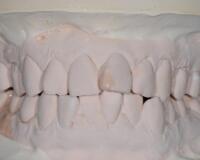 成都圣貝口腔醫(yī)院做了全冠修復(fù)，牙齒排齊美白前后對(duì)比果圖