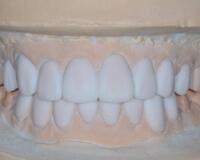 成都圣貝口腔醫(yī)院做了全冠修復(fù)，牙齒排齊美白前后對(duì)比果圖