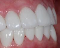 成都圣貝口腔醫(yī)院做了全冠修復(fù)，牙齒排齊美白前后對(duì)比果圖