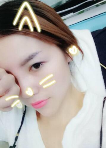 隆鼻整形一個(gè)月恢復(fù)期圖片 武漢壹加壹隆鼻整形案例