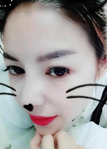 隆鼻整形一個(gè)月恢復(fù)期圖片 武漢壹加壹隆鼻整形案例