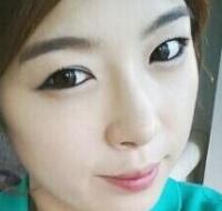 武漢藝齡整形醫(yī)院做駝峰鼻矯正價(jià)格12k，真實(shí)案例恢復(fù)過程圖