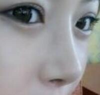 武漢藝齡整形醫(yī)院做駝峰鼻矯正價(jià)格12k，真實(shí)案例恢復(fù)過程圖