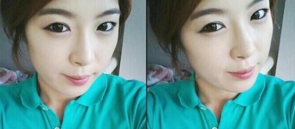 武漢藝齡整形醫(yī)院做駝峰鼻矯正價格12k，真實案例恢復(fù)過程圖