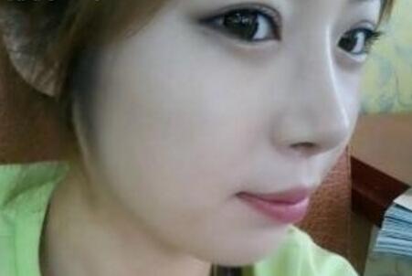 武漢藝齡整形醫(yī)院做駝峰鼻矯正價格12k，真實案例恢復(fù)過程圖