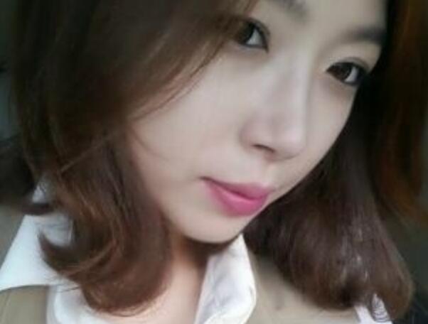 武漢藝齡整形醫(yī)院做駝峰鼻矯正價格12k，真實案例恢復(fù)過程圖