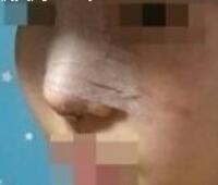 鼻翼縮小和隆鼻手術(shù)對(duì)比圖和整形日記——武漢藝齡醫(yī)院