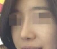 鼻翼縮小和隆鼻手術(shù)對(duì)比圖和整形日記——武漢藝齡醫(yī)院