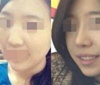 鼻翼縮小和隆鼻手術(shù)對(duì)比圖和整形日記——武漢藝齡醫(yī)院