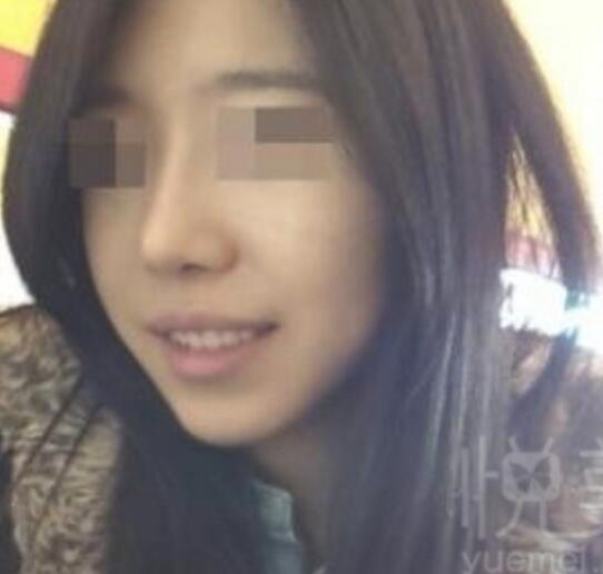 鼻翼縮小和隆鼻手術(shù)對比圖和整形日記