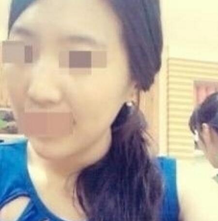 鼻翼縮小和隆鼻手術(shù)對比圖和整形日記