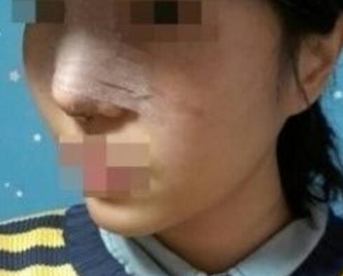 鼻翼縮小和隆鼻手術(shù)對比圖和整形日記