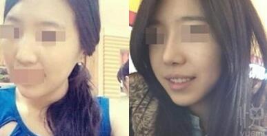 鼻翼縮小和隆鼻手術(shù)對比圖和整形日記