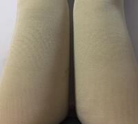 水動力吸脂減肥瘦大腿手術(shù)前后對比圖和恢復(fù)過程 武漢藝齡整形