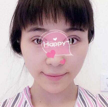 割雙眼皮手術(shù)價格 雙眼皮對比圖恢復(fù)過程