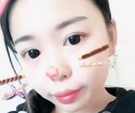 切開(kāi)雙眼皮+開(kāi)眼角手術(shù)前后對(duì)比圖恢復(fù)過(guò)程