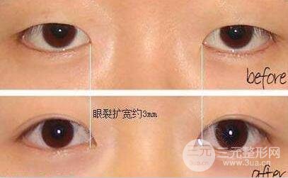 開(kāi)眼角和雙眼皮可以一起做嗎？